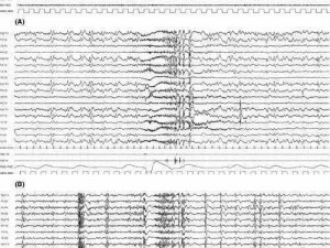 超过2500次痉挛_癫痫发作超过 2500 次，大脑还能正常工作吗？