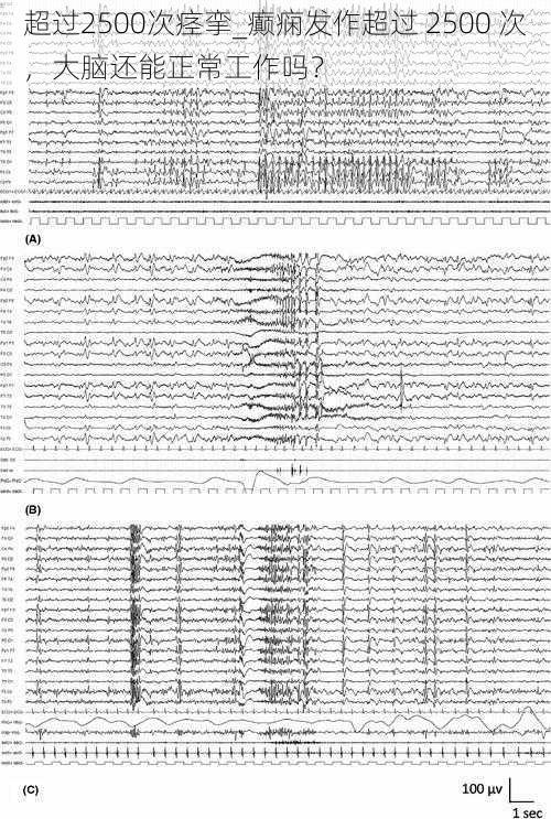 超过2500次痉挛_癫痫发作超过 2500 次，大脑还能正常工作吗？